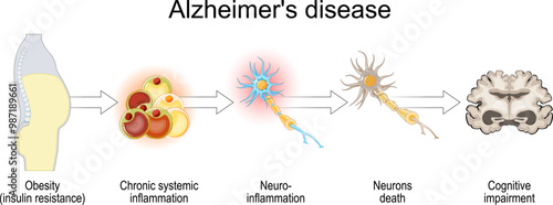 Alzheimers disease and insulin resistance.