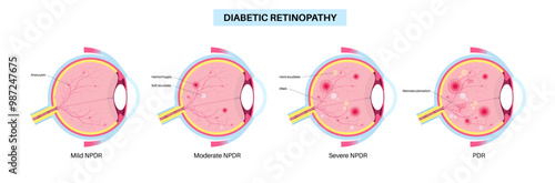 Diabetes related retinopathy