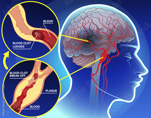 Ischemic stroke. Brain's blood vessels become narrowed or blocked. Healthcare illustration. Healthcare infographic. Vector illustration. 