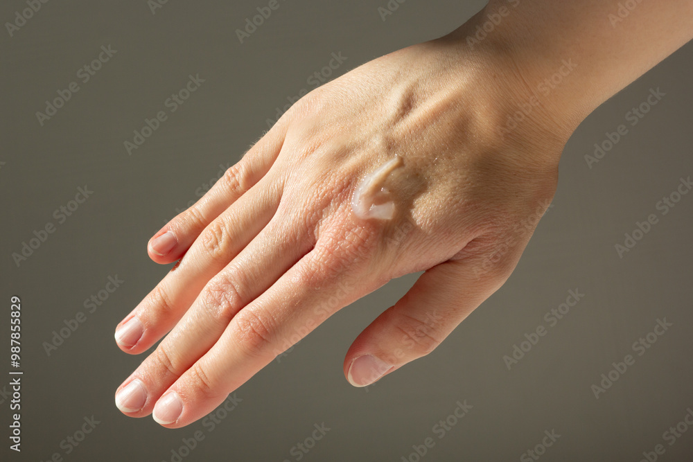 Close-up of a woman applying petroleum jelly to eczema on her hands.