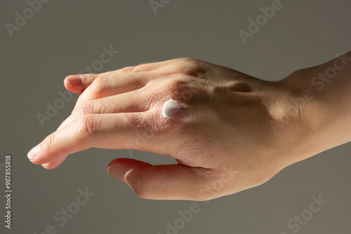 Close-up of a woman applying a topical treatment to eczema on her hands.
