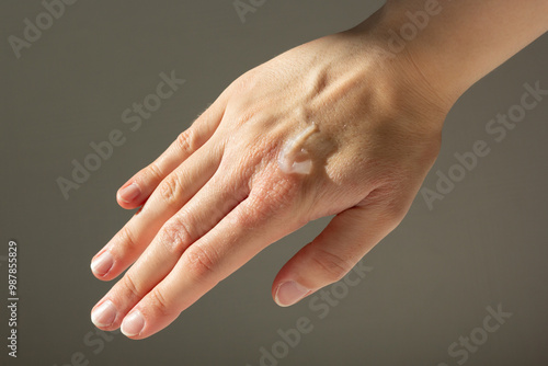 Close-up of a woman applying petroleum jelly to eczema on her hands.