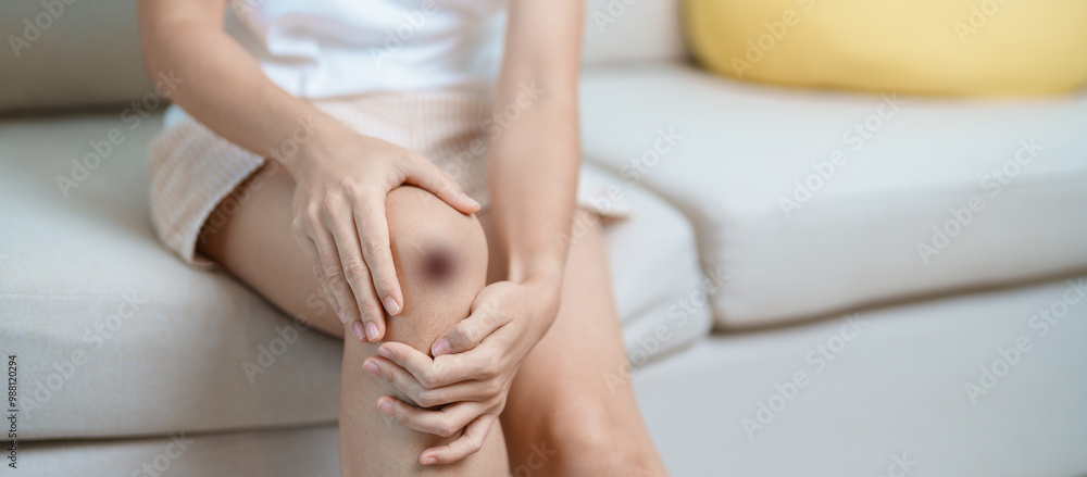 Obraz premium Bruise, wound and Contusion concepts. Woman having bruised on Knee and leg due to accident. Skin Injury, body pain and ache
