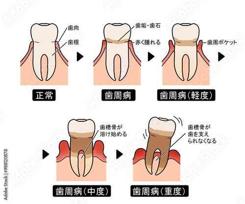 歯周病の進行（文字あり）