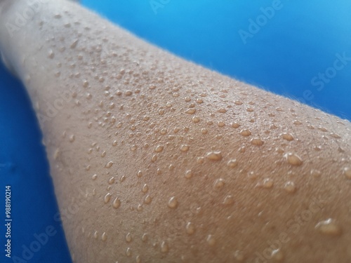 Hyperhidrosis, Excessive sweating, sweat droplets on the skin, sweating because of the hot weather.