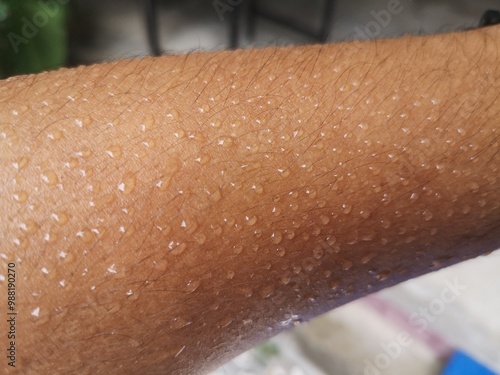 Hyperhidrosis, Excessive sweating, sweat droplets on the skin, sweating because of the hot weather.