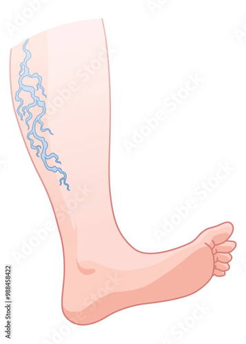Varicose veins. Blue blood vessel visible through the skin, abnormally swollen leg. Vascular disease diagnostic and treatment. Venous insufficiency medical disease