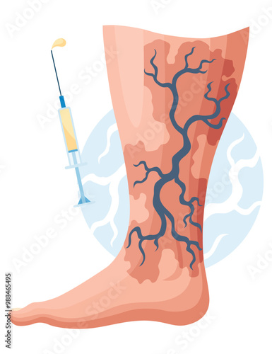 Stages or types of varicose veins development. Medical poster or disease infographic. Image of diseased legs. Vector illustration in flat style