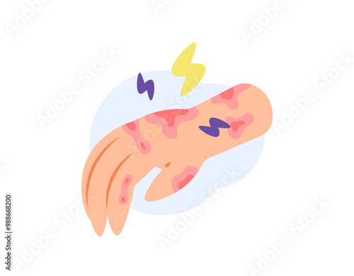 illustration of a hand with sensitive skin. red, irritated, itchy and sore hand skin. allergy. health problems and skin diseases. flat style design. elements