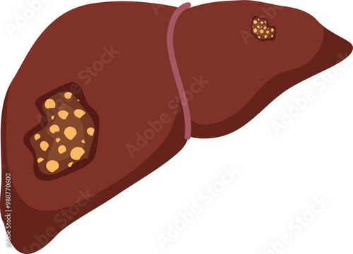 Liver disease illustration 