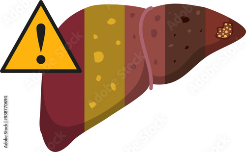 Liver disease illustration 