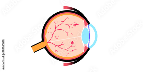 Diabetes related retinopathy