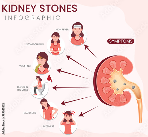 Kidney Stones Symptoms Infographic Identifying Pain, Nausea, and Urinary Discomfort