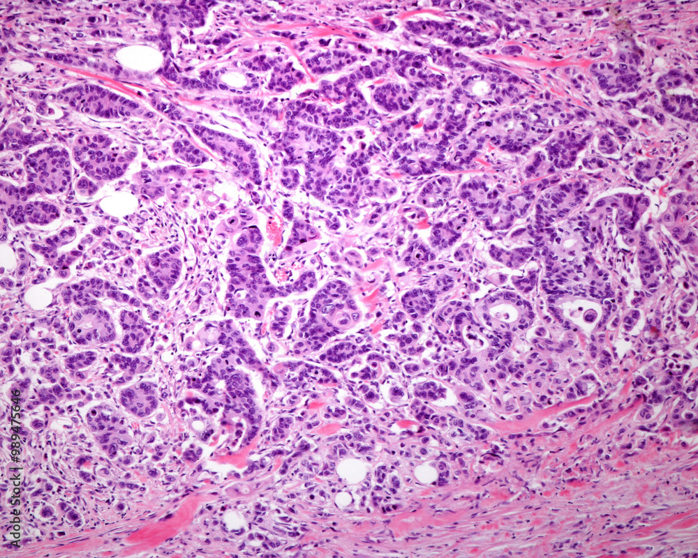 Obraz premium Human breast. Malignant carcinoma