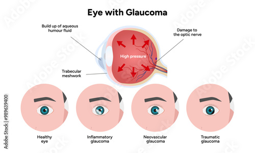 Healthy eye and eye with glaucoma. Ophthalmology eye anatomy. Inflammatory glaucoma. Neovascular glaucoma. Traumatic glaucoma