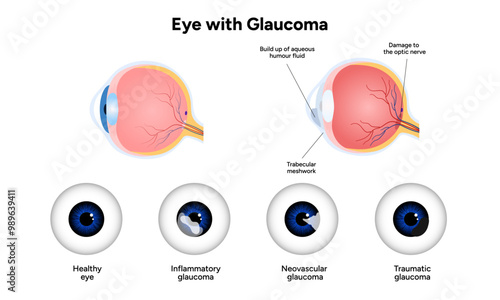 Healthy eye and eye with glaucoma. Ophthalmology eye anatomy. Inflammatory glaucoma. Neovascular glaucoma. Traumatic glaucoma