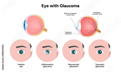 Healthy eye and eye with glaucoma. Ophthalmology eye anatomy. Inflammatory glaucoma. Neovascular glaucoma. Traumatic glaucoma