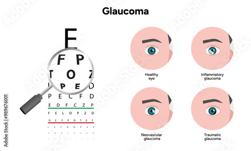 Healthy eye and eye with glaucoma. Ophthalmology eye examination. Inflammatory glaucoma. Neovascular glaucoma. Traumatic glaucoma