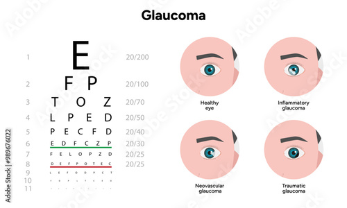 Healthy eye and eye with glaucoma. Ophthalmology eye examination. Inflammatory glaucoma. Neovascular glaucoma. Traumatic glaucoma