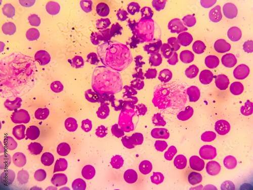 Chronic myeloid leukemia cells or CML, analyze by microscope. Blood cancer cells image. photo