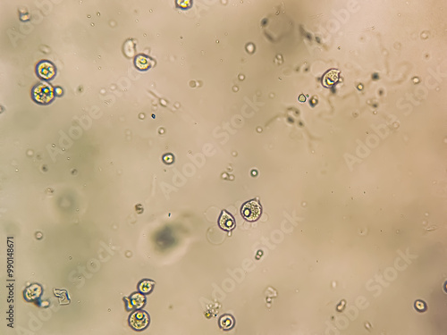 Trichomonas vaginalis in urine sediment analysed by microscope. It's a preventable and curable sexually transmitted protozoan that infects the urogenital tract.