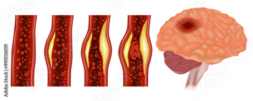 Intracranial atherosclerosis disease. Artery narrowed by plaque and Normal artery. Atherosclerotic plaque. Stroke or cerebrovascular accident or brain attack. 