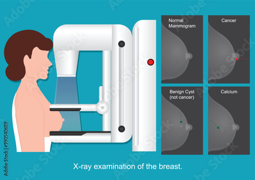 X ray examination of the breast.