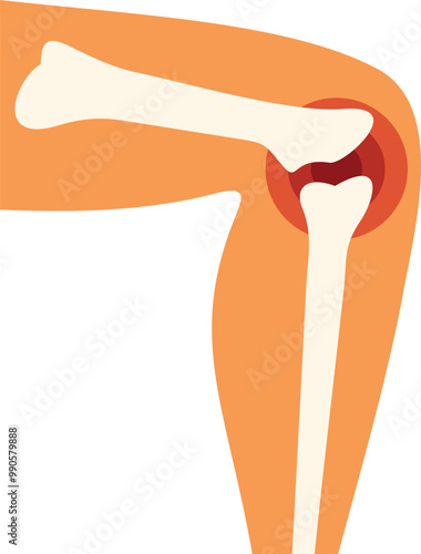 Illustration of a human leg with the skeleton showing, highlighting pain in the knee area