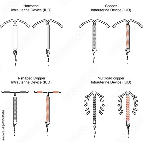 Set of four intrauterine devices (IUDs) including hormonal, copper, T-shaped copper, and multiload copper IUD. Contraceptive devices used for long-term pregnancy prevention.