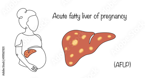 Acute fatty liver of pregnancy