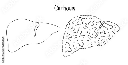 Cirrhosis
