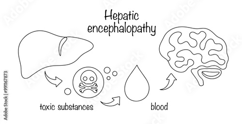 Hepatic encephalopathy