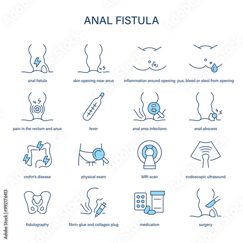 Anal Fistula symptoms, diagnostic and treatment vector icon set. Medical icons.