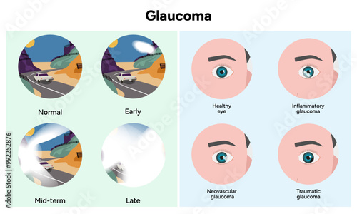Healthy eye and eye with glaucoma. Inflammatory glaucoma. Neovascular glaucoma. Traumatic glaucoma. Early, mid-term and late glaucoma