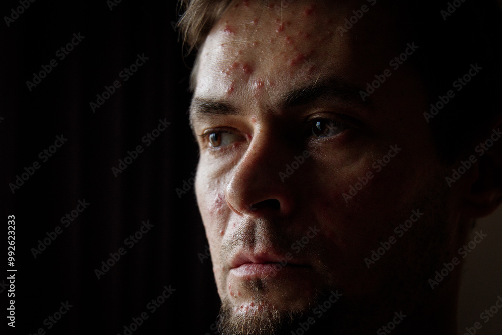 Sick sad man portrait, adult chickenpox. Sick sad man portrait, adult chickenpox.