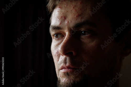 Sick sad man portrait, adult chickenpox. photo