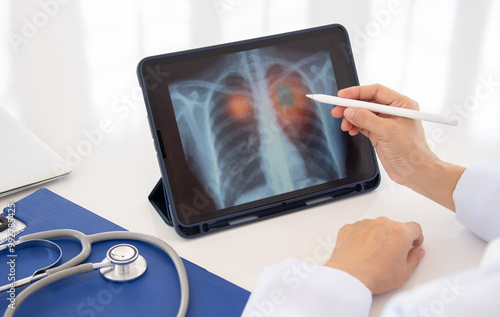 lung cancer pneumonia lung emphysema concept. doctor explaining results of lung check up by x-ray chest image on digital tablet screen to patient. photo