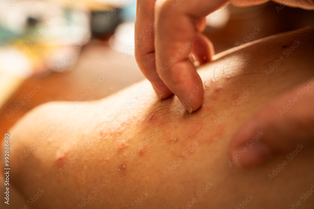 Fototapeta premium Scratching on rash on leg skin