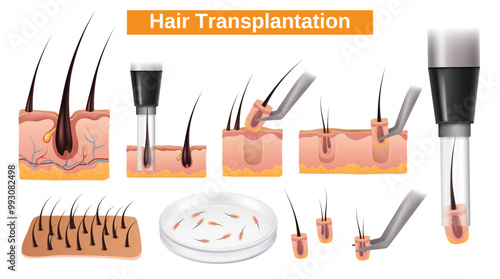 Realistic hair transplantation element set