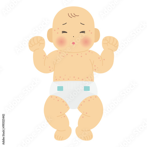湿疹がでた赤ちゃんのイラスト