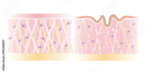 Comparison of healthy and wrinkle structure skin layer vector illustration isolated on white background. Cross section of intact and broken collagen, elastin fibers, fibroblasts. Skin care and beauty.
