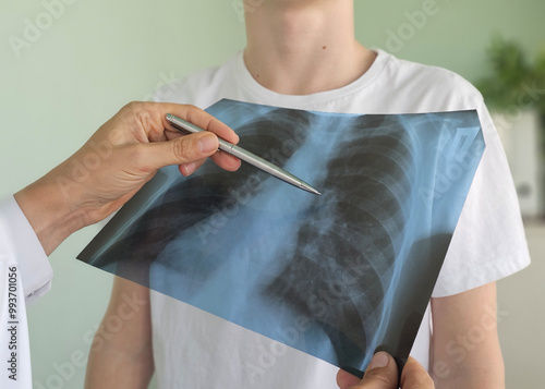 Schilderij op canvas x ray thorax,doctor looks at the picture in the hospital for pneumonia and cance