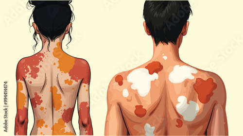 vitiligo Skin illustration