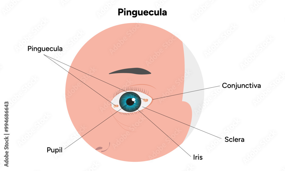 Fototapeta premium Pinguecula yellow spots in eye. Ophthalmology problem