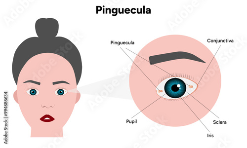 Pinguecula yellow spots in eye. Ophthalmology problem