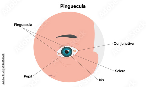 Pinguecula yellow spots in eye. Ophthalmology problem