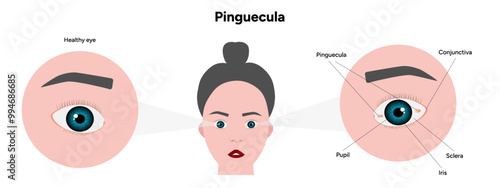 Pinguecula yellow spots in eye. Ophthalmology problem