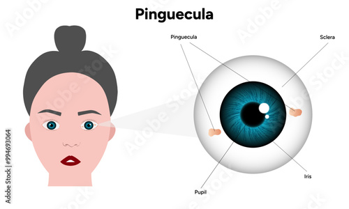 Pinguecula yellow spots in eye. Ophthalmology problem