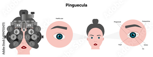 Eye testing. Pinguecula yellow spots in eye. Ophthalmology problem