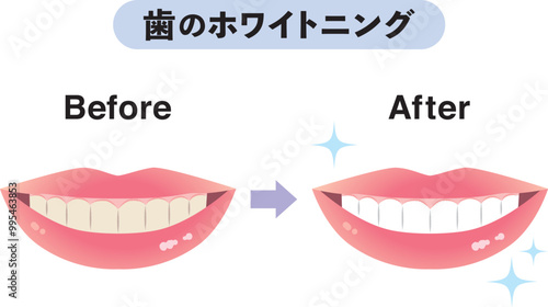 歯のホワイトニングのビフォーアフター